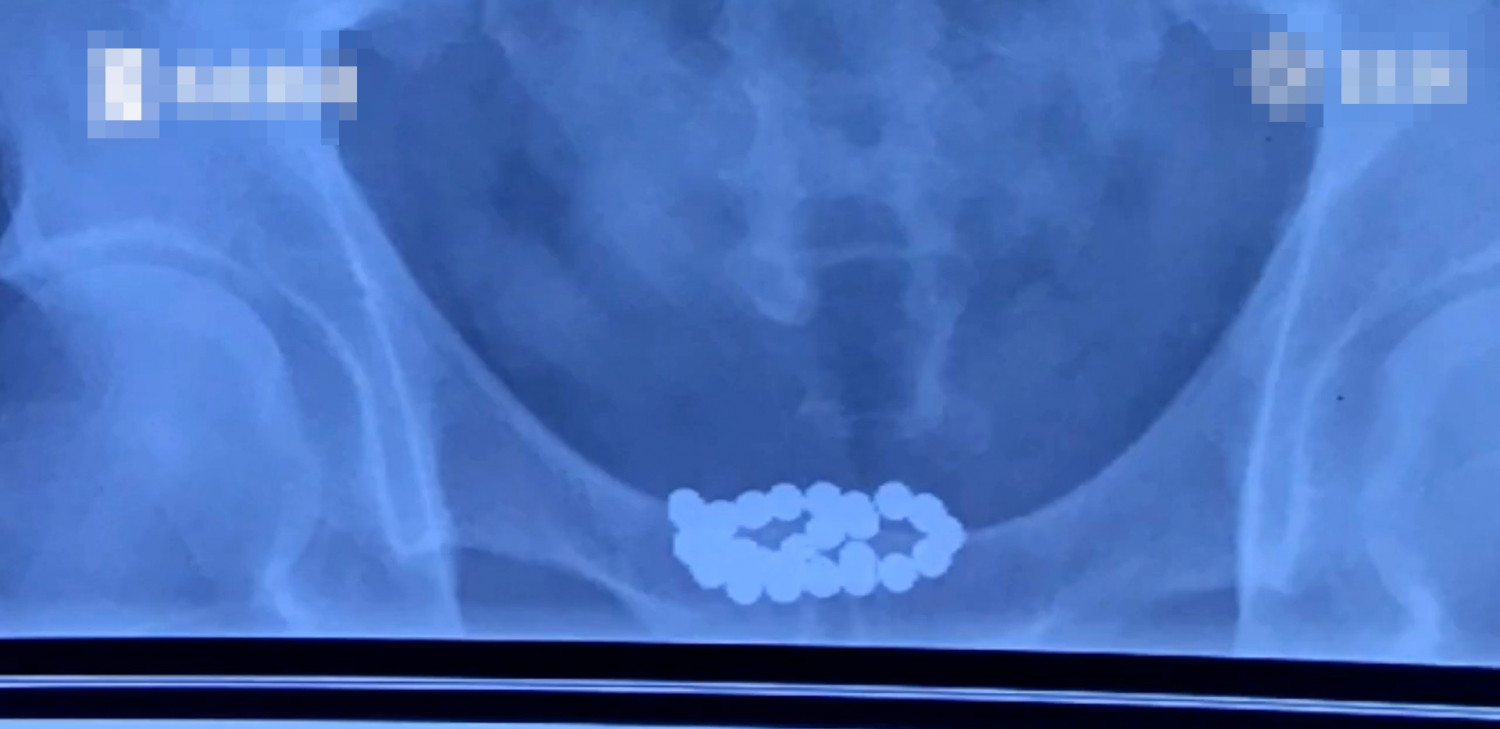 29颗磁力珠塞入尿道西安男忍痛10天始求医取出 星岛日报
