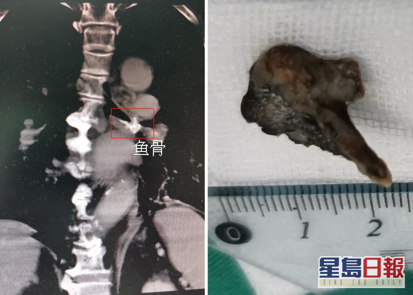 廣東老翁魚骨卡氣管逾60年 醫院施手術成功取出 | 星島日報