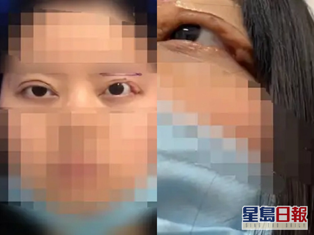 割雙眼皮2個月後整塊眼皮掉落內地女6年無法閉眼狂流眼淚 星島日報