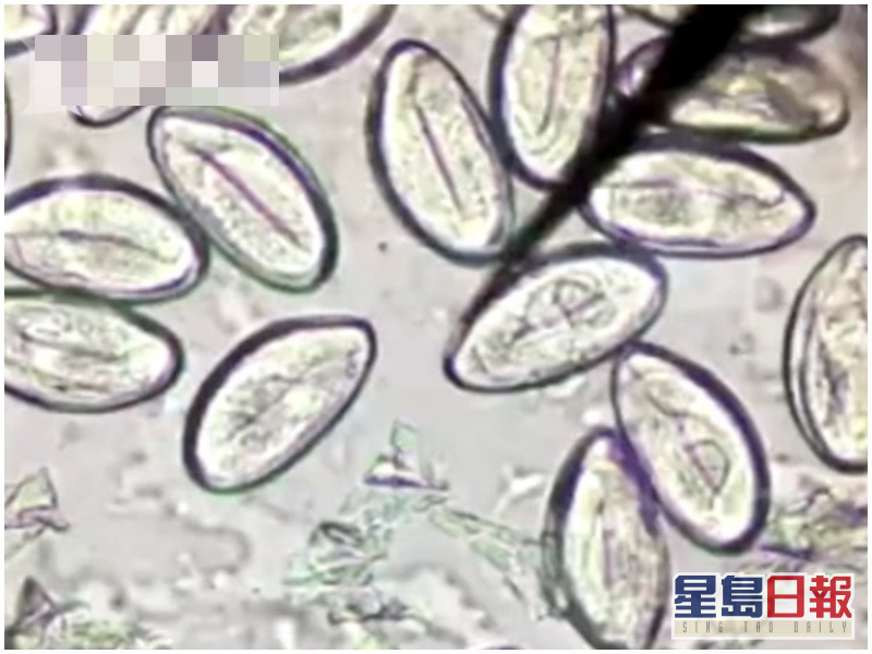 3年生食淡水魚患肝吸蟲病無知男覺得蘸芥末可殺寄生蟲 星島日報