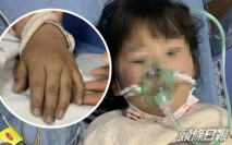 5歲女童吃自家製泡菜中毒 嘴唇發紫險喪命
