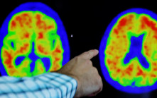 科學家發現人腦尺寸百年來不斷增長 惟近年平均智商倒退