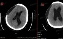 為祛濕治病高溫曬背2小時  浙江6旬婦陷昏迷開顱保命