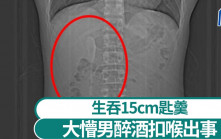 生吞15cm匙羹︱大懵男醉酒扣喉出事 半年後才發現逃死劫