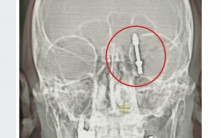 恐怖植牙！牙醫疑用力過猛  螺絲釘插穿病人頭骨直嵌大腦