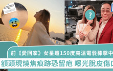 前《愛回家》女星遭150度高溫電髮棒擊中面部 額頭現燒焦痕跡恐留疤 曝光脫皮傷口照
