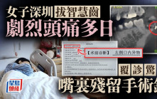 深圳拔智齒後劇烈頭痛多日 女子覆診驚見「嘴裡殘留手術針」