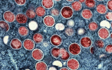 北京發現兩宗猴痘病例 均為親密接觸感染