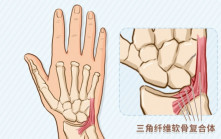 專欄 運動醫道│TFCC手腕三角纖維軟骨受傷