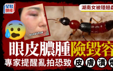 湖南女被蟲咬險毀容  專家提醒不能直接拍死
