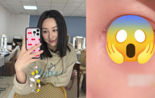 高海寧受一病症纏擾發放恐怖病容  眼部超紅腫又痕又痛叫救命  網民推測一原因病發