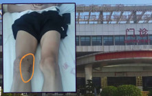 左右不分︱廣西17歲田徑健兒左膝長骨瘤   醫生手術錯切右膝