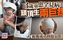 罕見病︱福建3歲童頭頂兩巨痣  5個月兩施手術與「米奇老鼠」說再見