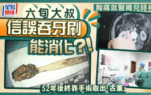 生吞牙刷｜64歲大叔兒時誤以為能消化  絞痛靠手術取52年「古董」