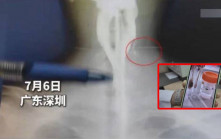深圳男頸痛揭藏7粒瓜子20年  原來與一身體漏洞有關