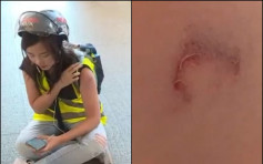 【修例风波】荃湾警方放催泪弹 Now女记者手臂中弹烧伤