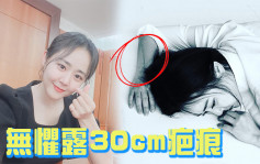 文瑾瑩做4次手術保住隻手  IG晒近照無懼露30cm疤痕