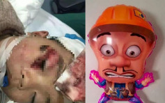 氢气球惹祸 3岁男孩眼睛被炸缝逾100针