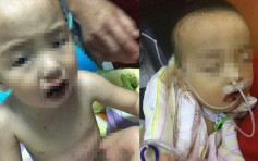 濟南1歲童誤吞哥士的 嚴重灼傷或致啞