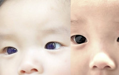 服法匹拉韋治療新冠　泰6月大男嬰眼珠變藍