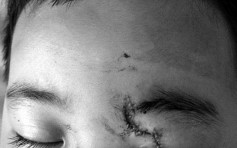 湖南五歲童飛來橫禍　午睡爆玻璃左眼遭插盲
