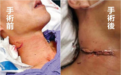 网传被割颈警术后照惹争议 医管局澄清:皮瓣轻微外翻助伤口愈合
