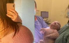 21歲母誕英史上第2重巨嬰 孕肚太大滿佈妊娠紋幾乎完全裂開