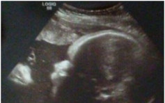 美國孕婦超聲波掃描 稱見耶穌影像