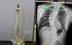 【健康talk】脊柱側彎影響長高及心肺功能 脊醫教6大檢查重點及伸展運動 