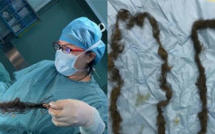 武汉女卵巢藏畸胎瘤 医生取出2米毛发