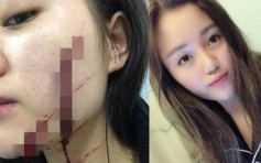 18歲少女被砍臉毀容 只因鬧室友聚會太嘈