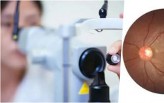 溫州20歲女染疫發燒3日後近乎失明 診斷為急性視網膜病變