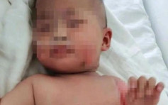 杭州6个月大女婴被烫伤 外公用「白酒毛巾」包裹致休克