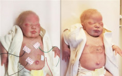超薄無線感應器造福患病嬰兒 免除儀器電線傷害