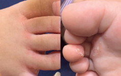 在外公家经常打赤脚 两岁男婴惊患香港脚 