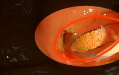 廣東男常生食淡水魚蝦 體內肝臟排出活蟲