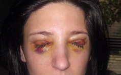 澳洲女患上怪病 眼皮會自動黏合並3天不能睜開