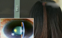 21岁深圳女生关灯玩手机 视网膜脱离引发白内障