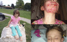 6岁女童用搓手液顽童在旁打火 引发抢火烧脸致毁容