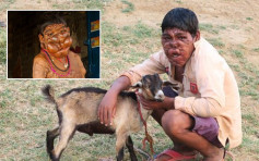 印度「鬼男孩」移除脸部肿瘤　首次能够看到脸部