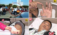 廣州駕校教練遭惡同事西瓜刀追斬　左手中指險斷