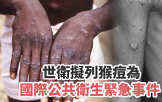猴痘蔓延｜世卫拟列为国际公共卫生紧急事件 与新冠伊波拉同列
