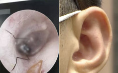 杭州女子耳朵痛了一夜 醫生竟從耳道取出活蜘蛛