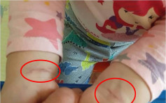 2岁女童手腕疑有勒痕 母控台南幼稚园虐儿