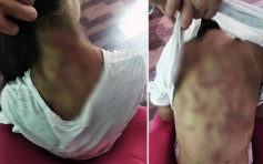 四川12岁女孩遭后母虐打 伤痕触目惊心