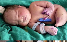 印度妈诞「美人鱼」宝宝 双脚相连仅活了15分钟