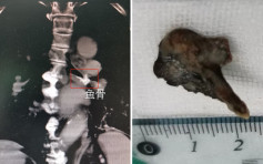 广东老翁鱼骨卡气管逾60年 医院施手术成功取出