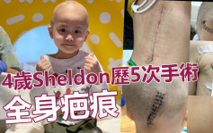 4歲Sheldon歷5次手術從容面對 母心痛：細小身軀滿布疤痕