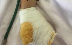 2岁女童好奇用叉插拖板 被电飞左手严重烧伤　