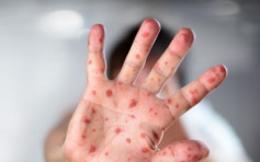欧洲麻疹旅客途经纽约 美官员呼吁民众留意有否出现症状